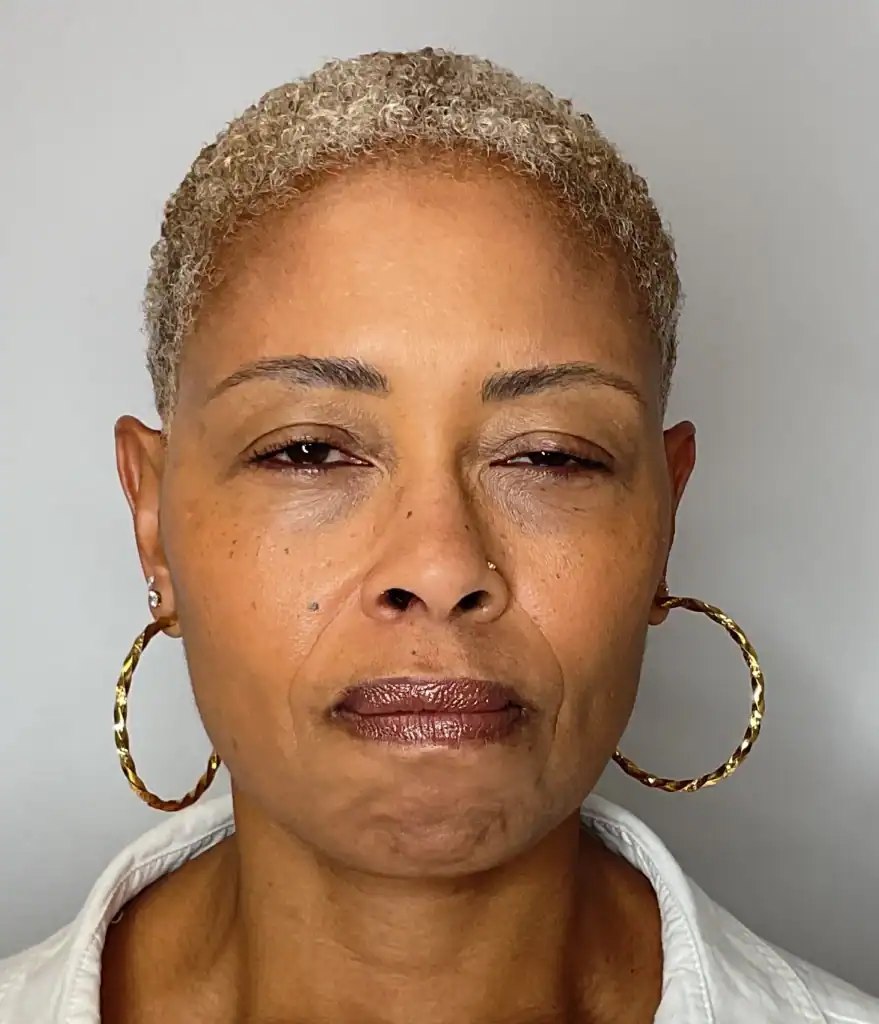 After - Wrinkle Treatments / Dysport<br>Patient 140