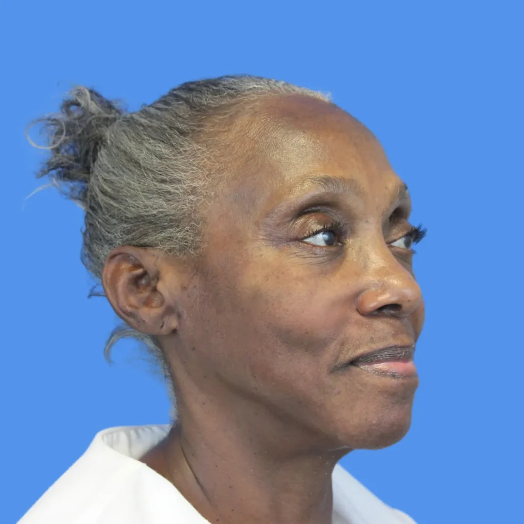 After - InstaLift / Thread Lift Patient 5