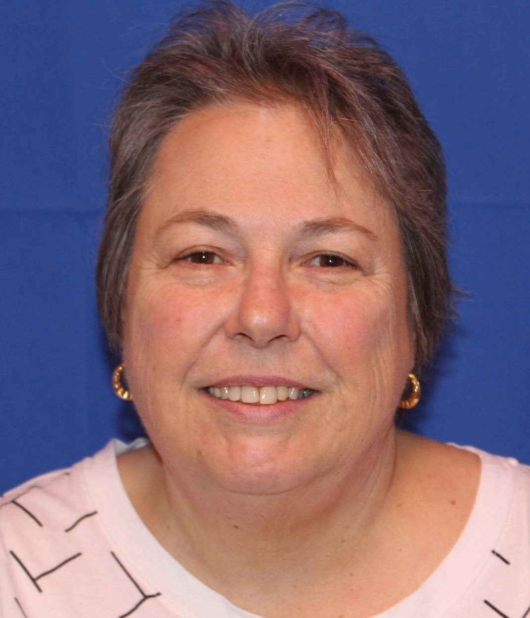 After - Laser Treatment for Redness Patient 99