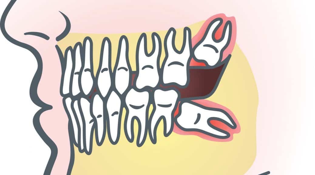 problems with wisdom teeth