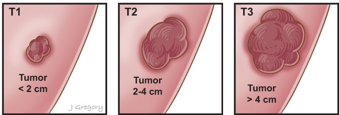 oral cancer diagnosis