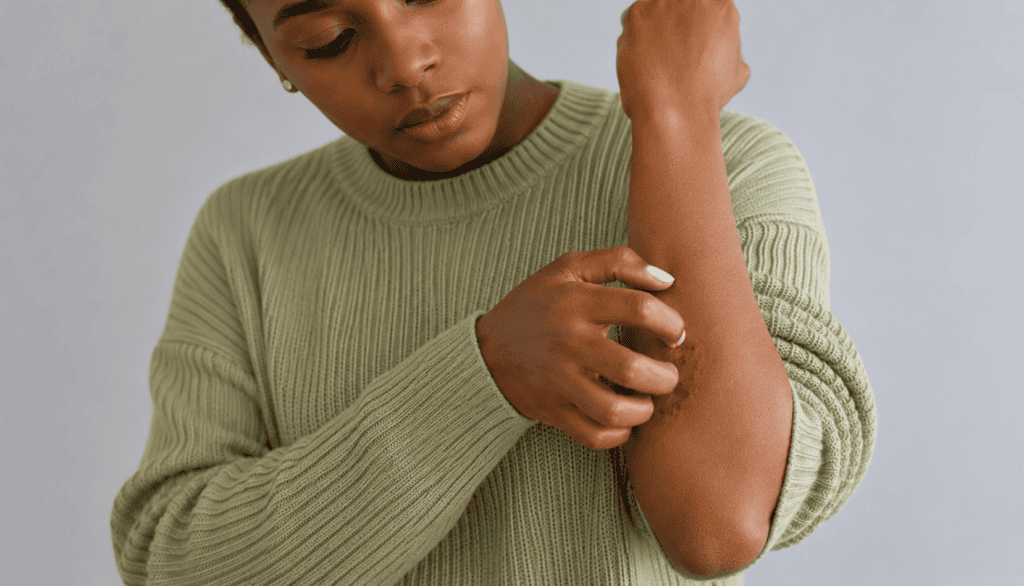 Woman applying cream to eczema-affected skin on arm.