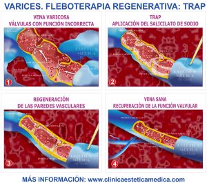 &nbsp;>thisisjustarandomplaceholder<Varices Tratamiento Regenerativo | Iberian Press®&nbsp;