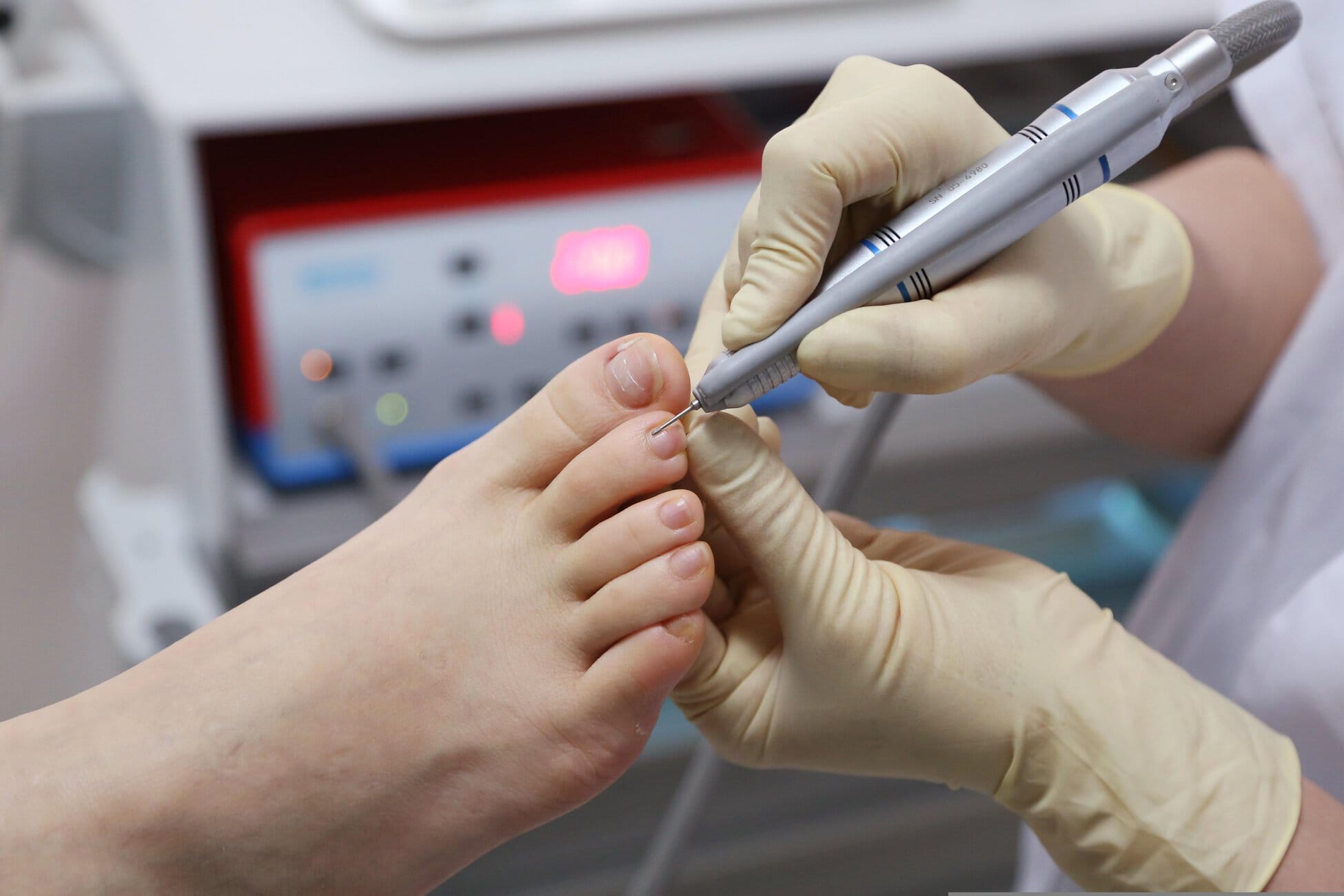 Medical professional wearing gloves treating a patient’s toe with a handheld instrument for foot care.