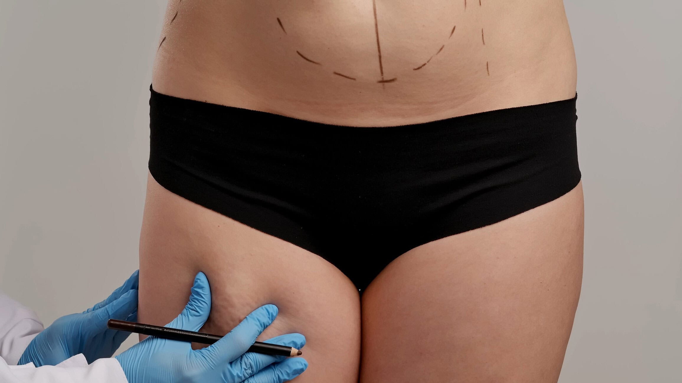 Close-up of a midriff with surgical skin markings and a gloved hand holding a marker, preparing for an abdominal procedure.