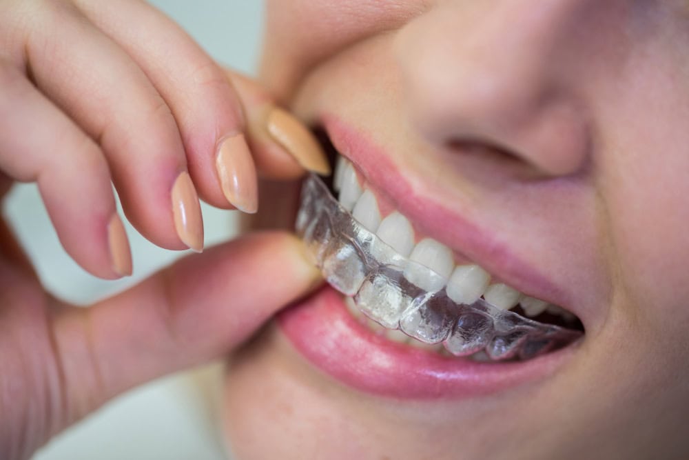 Close-up of a person fitting a clear dental aligner over the teeth with fingers on the tray edge.