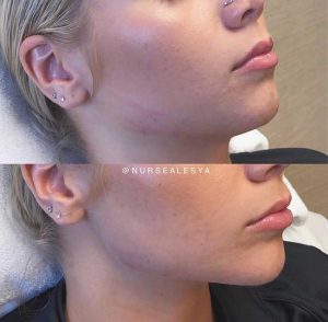 Before and after jawline filler enhancement results