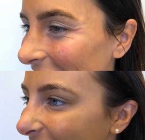 Before and after facial redness reduction treatment