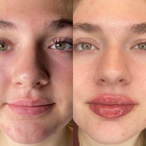 Before and after lip filler enhancement close-up