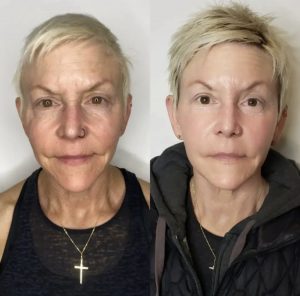 Side-by-side woman before and after skincare treatment