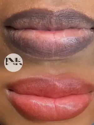 Lip neutralization Lakeland healed flush result