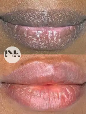 Lip neutralization Lakeland restoration detail