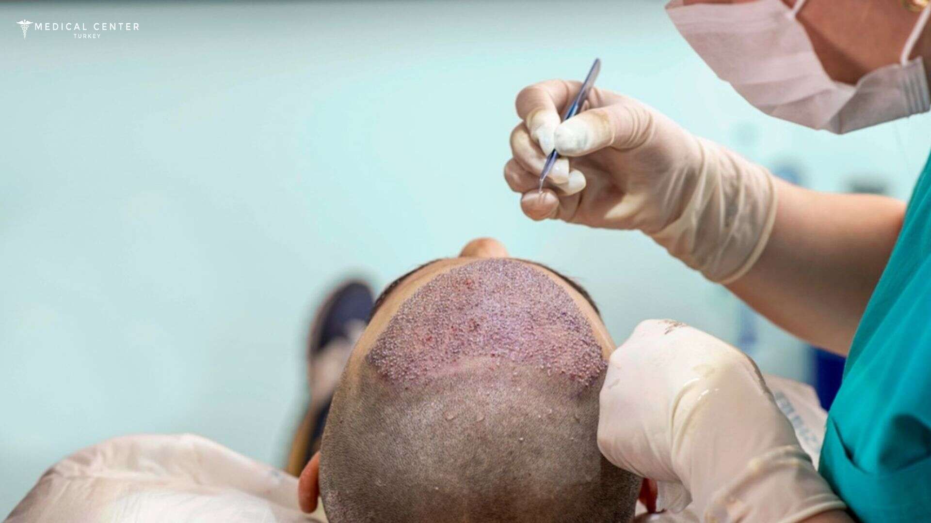 Hair Transplant Techniques Explained Step by Step