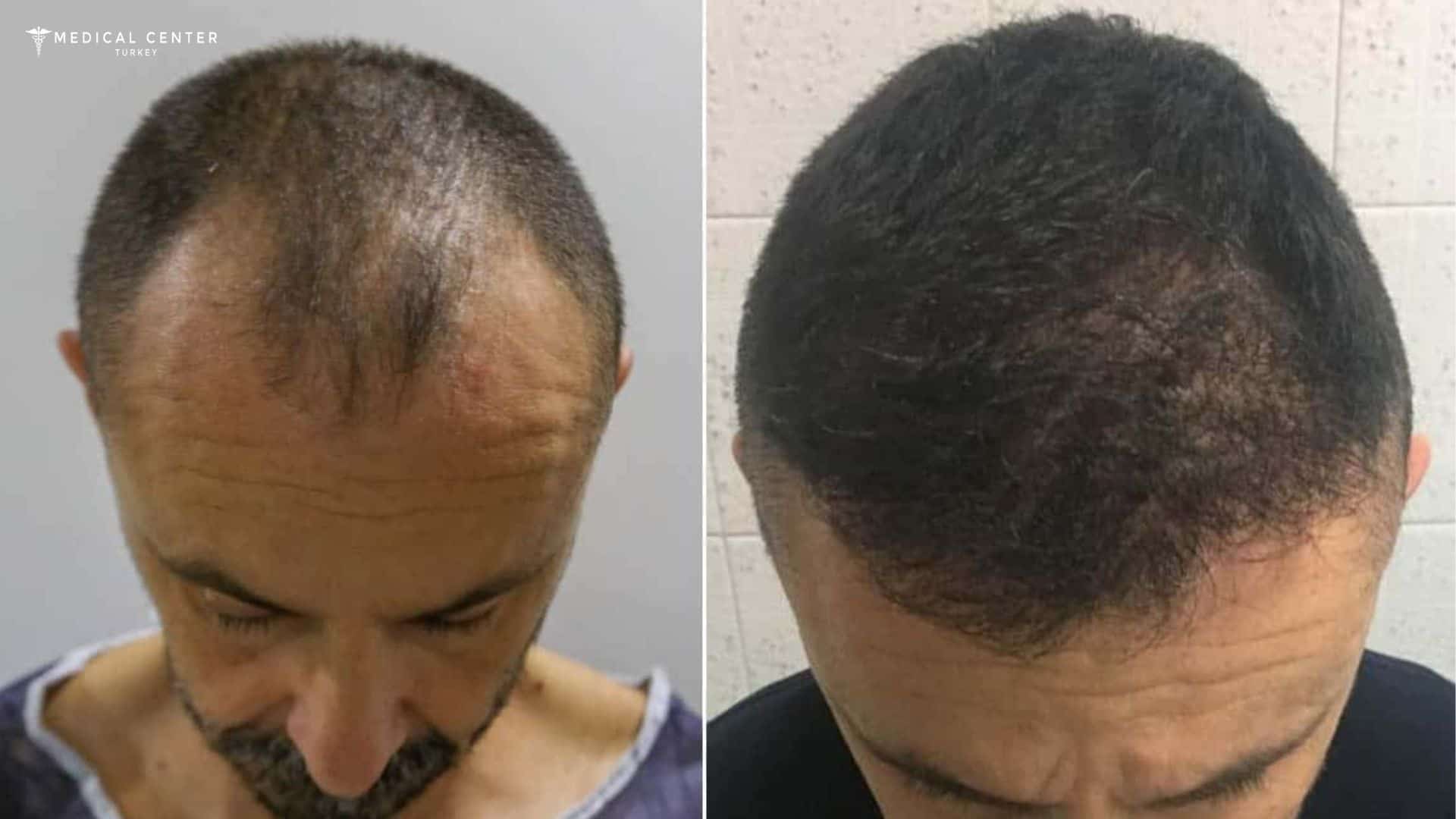 Hair Transplant Techniques Explained Step by Step