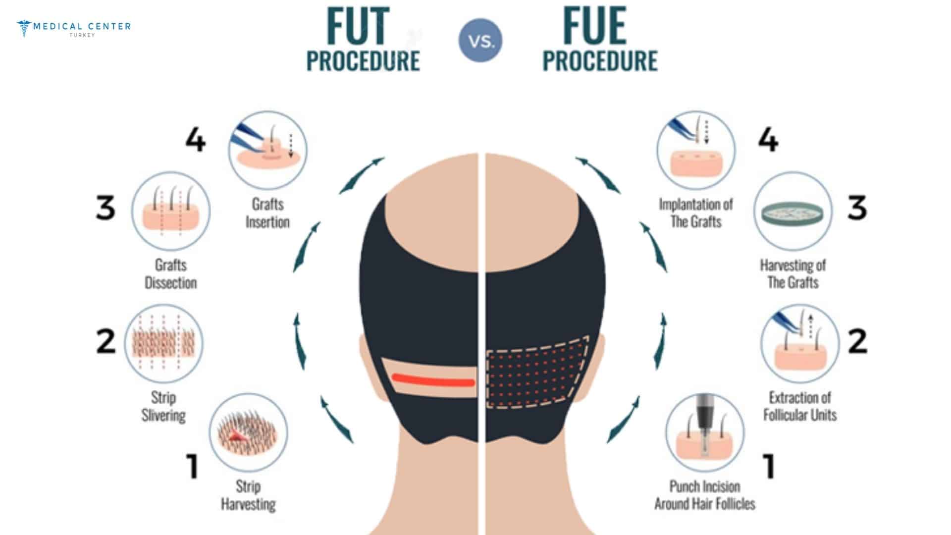 Hair Transplant Techniques Explained Step by Step
