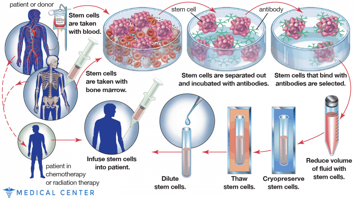 Bone marrow transplantation in Turkey