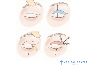 Blepharoplasty Price in Turkey