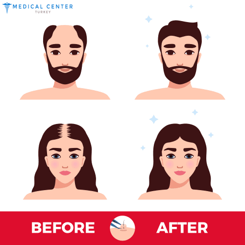 Hair_transplantation_before_after