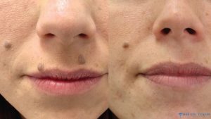 What is the cost of mole removal in Turkey 6