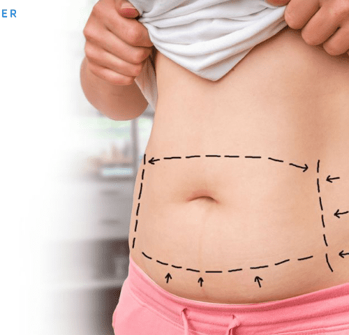 liposuction-in-turkey liposuction-in-turkey