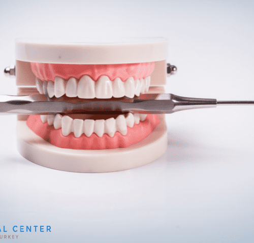The Complete Guide to Veneers in Turkey