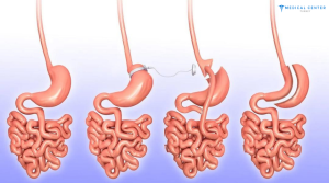 gastric sleeve surgery price 2