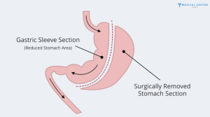 gastric sleeve surgery price 3