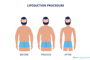 How Much is Liposuction In Turkey