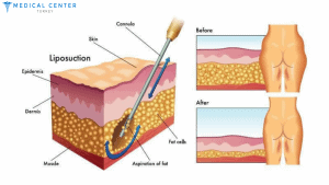 HowMuch is Liposuction In Turkey