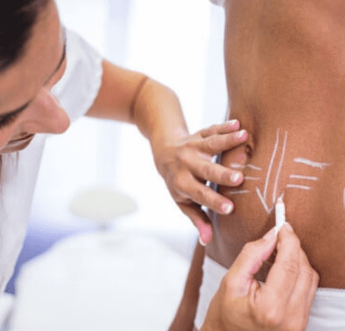 How_Much_Is_Liposuction_In_Turkey How_Much_Is_Liposuction_In_Turkey