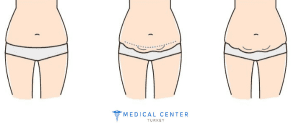 Tummy_tuck_cost_in_Turkey_3