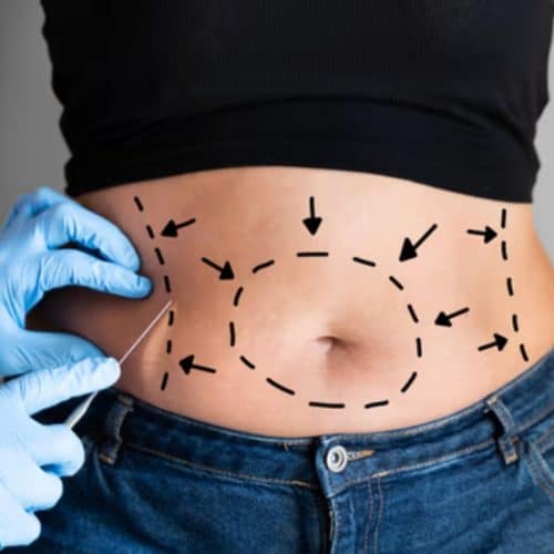 Frequently Asked Questions About Liposuction Frequently Asked Questions About Liposuction
