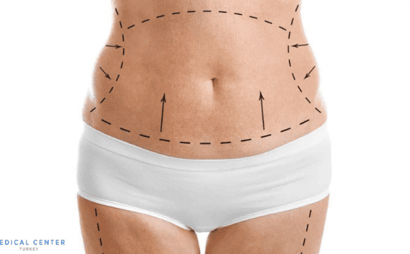 tummy tuck in turkey