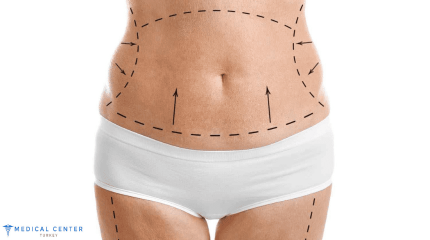 tummy tuck in turkey tummy tuck in turkey