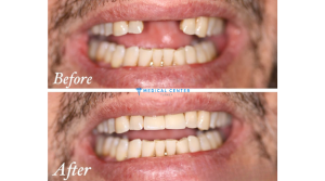 10 countries for Dental implants 3