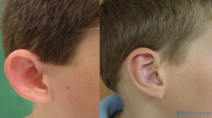 ear correction cost in turkey 1