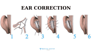 ear correction cost in turkey 3