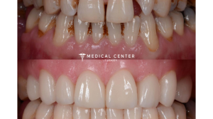 veneers 1