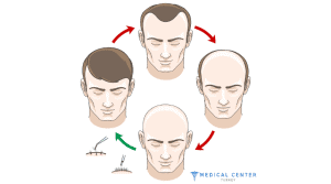 How Long Does It Take To See Results From Hair Transplant Surgery?