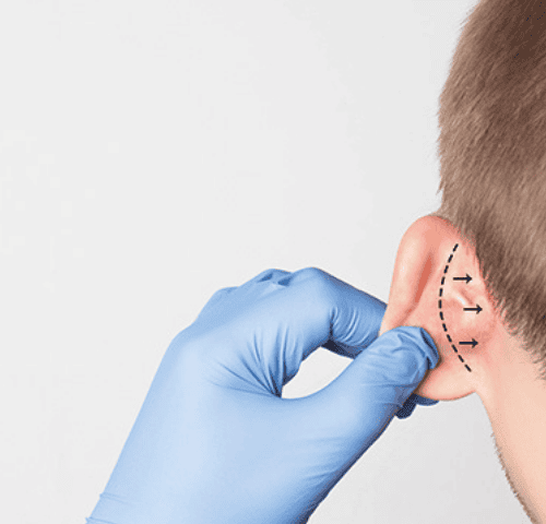 Ear Correction in Turkey