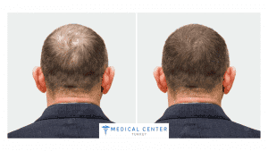 The Best Hair Transplant In Turkey