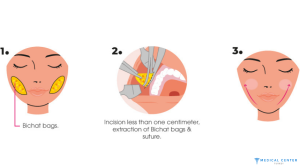 Bichectomy Surgery1
