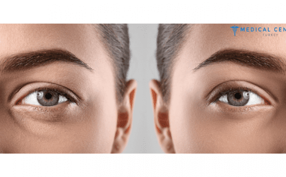 Blepharoplasty_In_Turkey