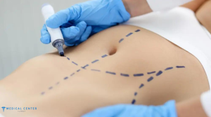 Body Mass Index (BMI) for Liposuction 2