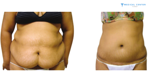Body Mass Index (BMI) for Liposuction 4