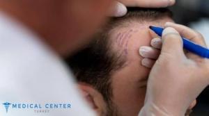 Is Turkey the Best Destination for Hair Transplants?