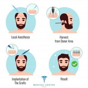 Hair_Transplant_Turkey