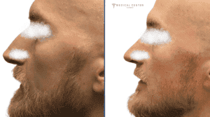 Rhinoplasty in Turkey: Types, Prices, Procedures