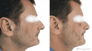 Rhinoplasty Surgery 