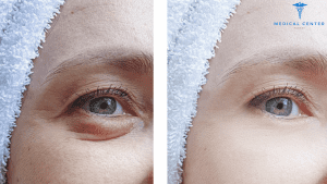 Blepharoplasty Price in Turkey